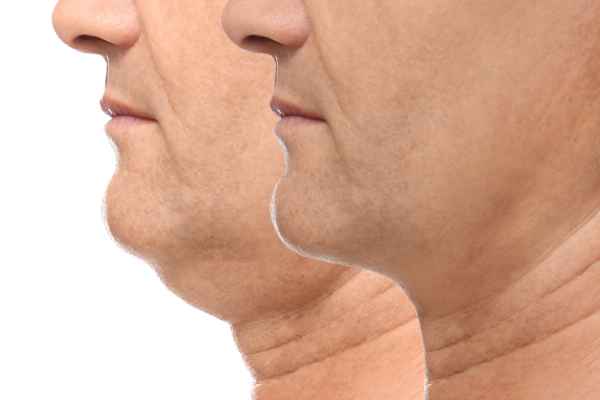 HIFU - Breakthrough in Anti - ageing 2 hifu results Wolverhampton