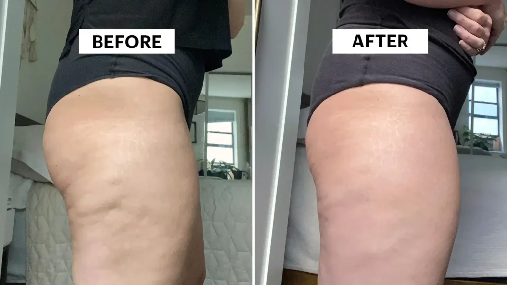 Sculpting Your Bum: Can Toning Exercises Really Reduce Cellulite? 1 Do Toning Exercise Wolverhampton Really Tackle Cellulite?