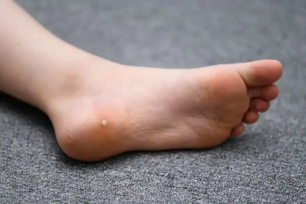 Cryotherapy For Warts And Also Verrucas 2 Image of verruca on the bottom of the foot that able to be treated with Cryotherapy Wolverhampton