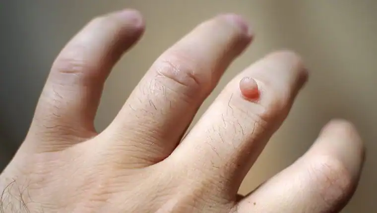 Cryotherapy For Warts And Also Verrucas 1 Image of blemish that Cryotherapy Wolverhampton can remove with Lipo 360.