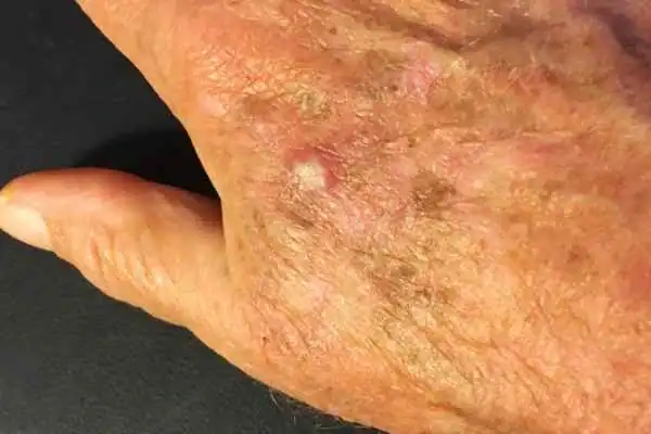 Cryopen For Actinic Keratoses 1 Image of Actinic keratoses Wolverhampton on a person hand