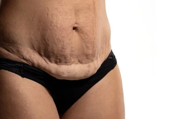The Science of Skin Tightening 1 The science behind skin tightening Wolverhampton picture of a woman's sagging skin on the stomach